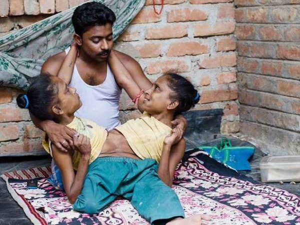 عشق یک مرد و دو خواهر دوقلوی به همچسبیده