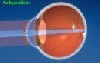 آستیگماتیسم (Astigmatism)