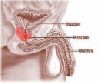 بررسی‌ جدید درباره‌ پروستات‌ 