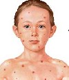 آبله‌ مرغان و علائم آن‌ Chickenpox 