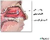 پولیپ‌ بینی ‌ Nasal polyps