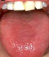 التهاب و قرمز شدن‌ زبان‌ (گلوسیت‌)tongue inflammation