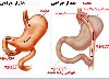 می‌خواهید با جراحی لاغر شوید؟