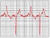 نوار قلب ( ECG ) چیست؟