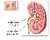 همه چیز درباره سنگ کلیه