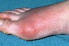 نقرس(gout)چیست؟