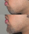 منتوپلاستی (mentoplasty) , جراحی زیبایی چانه