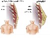 بزرگ شدن سینه , مشکل شایع پسران نوجوان