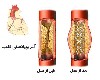 باز کردن عروق قلب با آنژیوپلاستی