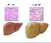 بیماری کبد چرب چیست ؟