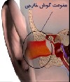 عفونت گوش منجر به پارگی پرده گوش می ‌شود