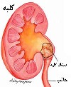 درمان موثر سنگ کلیه