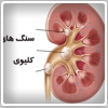 سنگ های کلیوی؛ علایم، علل , تشخیص و درمان