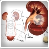 نکاتی درباره سنگ های ادراری