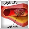 خطرات لخته شدن خون در رگ ها