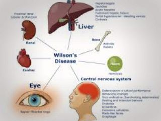 رسوب مس در مغز و کبد