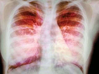 خوشه ۶ سانتی گندم در ریه بیمار ۱۲ ساله