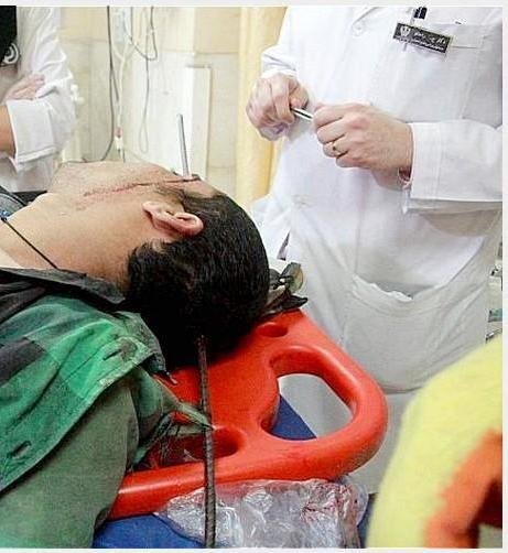 انجام جراحی نادر برای خروج میلگرد یک متری از سر یک کارگر در تهران