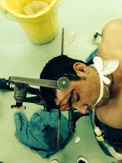 انجام جراحی نادر برای خروج میلگرد یک متری از سر یک کارگر در تهران