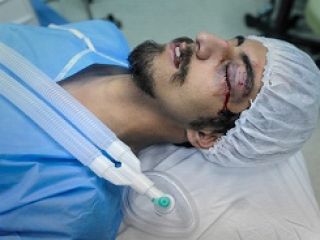 چهارشنبه سوری امسال ۲۲ قطع عضو به همراه داشت - ۲ قربانی نابینا شدند