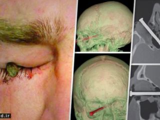 حادثه دلخراش برای مرد باغبان/ میخ باغبانی در چشم او از کنار مغزش عبور کرد