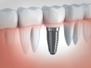۷ نکته‌ای که باید درباره ایمپلنت دندان بدانید