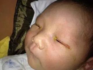 فلاش دوربین نوزاد ۳ ماهه را نابینا کرد