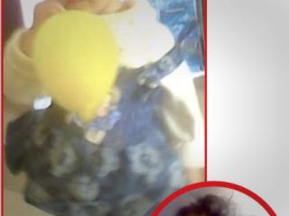 سرنوشت تلخ دختربچه ای که سوخت