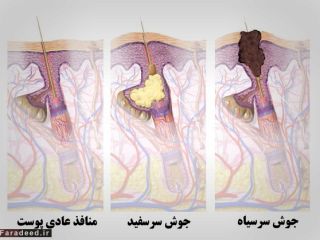 روش درمان قطعی جوش سرسیاه