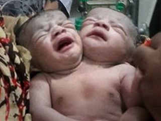 تولد نوزادی با دو سر در بنگلادش