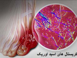 کاهش حملات نقرس با تغذیه ی درست