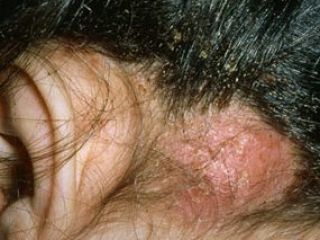 شپش؛ خوابگاه دانشجویان دکتری را تعطیل کرد!