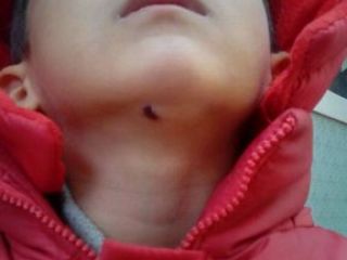 روایت متفاوت از ماجرای کشیدن بخیه کودک اصفهانی به روایت یکی از پرسنل بیمارستان