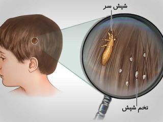 نشانه های شپش سر در بچه ها