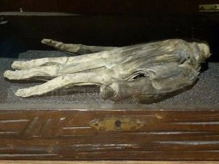 نگهداری دست قطع شده قانل!