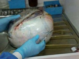 توده ۸ کیلوگرمی از شکم یک زن خارج شد