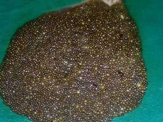 ۱۱۹۵۰ سنگ کیسه‌ صفرا در بدن یک بیمار!