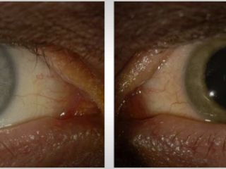 ابولا رنگ چشم یک پزشک مبتلا را تغییر داد