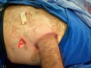 یک عمل جراحی نادر/ دست بیمار را به شکمش دوختند +عکس