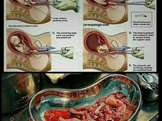 در سقط جنین عملا چه اتفاقی می افتد؟ - عکس