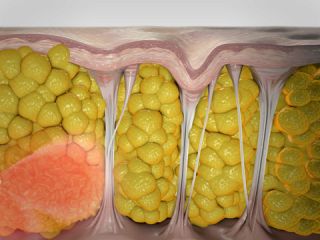 سلولیت چیست و چگونگی ایجاد آن - ۱