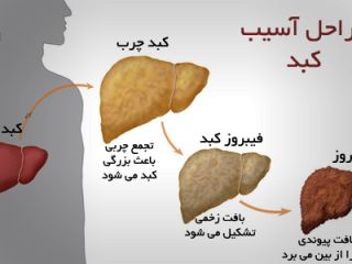 کبد چرب در کمین شکم گنده ها