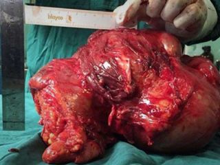 خروج تومور ۸ کیلویی از پای یک جوان + تصاویر