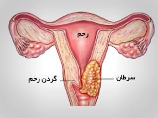 ۷ عامل ابتلا به سرطان گردن رحم