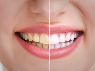 آیا تبلیغات جدید در مورد سفید کردن دندان با لیزر صحت دارد؟