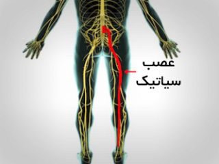 ۶ درمان طبیعی درد سیاتیک