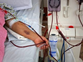 علت مرگ بیماران دیالیزی هنوز نامشخص است؛ اشتباه پزشکی یا نقص تجهیزات؟