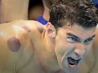 کبودی‌های مدور روی بدن ورزشکاران المپیک از چیست؟