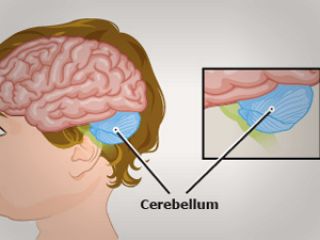 بیماری آتاکسی چیست؟ علائم و درمان آتاکسی