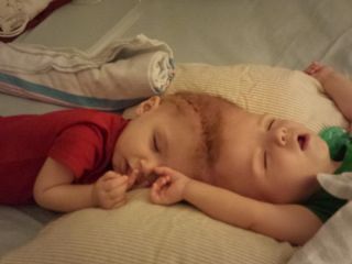 در عملی ۱۶ ساعته، دوقلوهای از سر به هم چسبیده جدا شدند